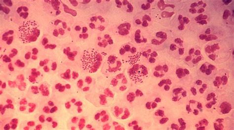 Cdc Reports A Surge In Gonorrhea Other Sexually Transmitted Diseases