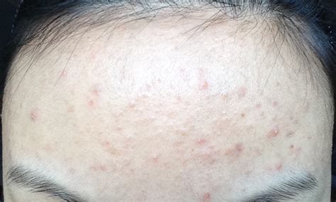 Diaper dermatitis may be accompanied by a candida infection of the mouth (thrush). Do I have Pityrosporum Folliculitis? - Adult acne - Acne ...