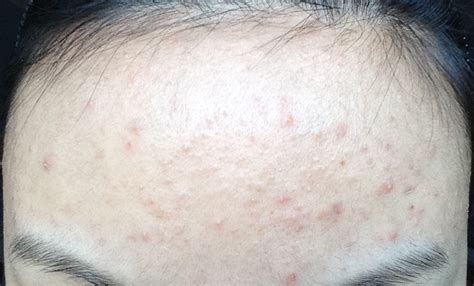 Vitamins, herbal supplements, etc.), allergies. Do I have Pityrosporum Folliculitis? - Adult acne - Acne ...