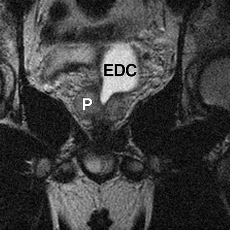 Endorectal Mri Of Prostatic And Periprostatic Cystic Lesions And Their Mimics Ajr