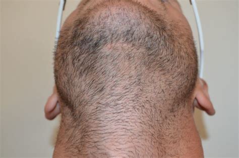 Body Hair Transplant Hairline Clinic Body Hair Experts