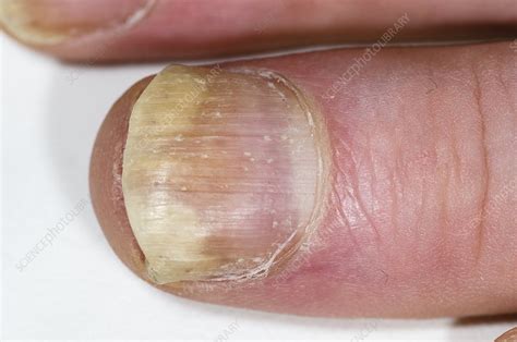 Psoriasis Of The Fingernail Stock Image C0156014 Science Photo