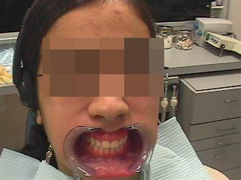 Gummy Smile Correction Dr Galil Clinical Cases