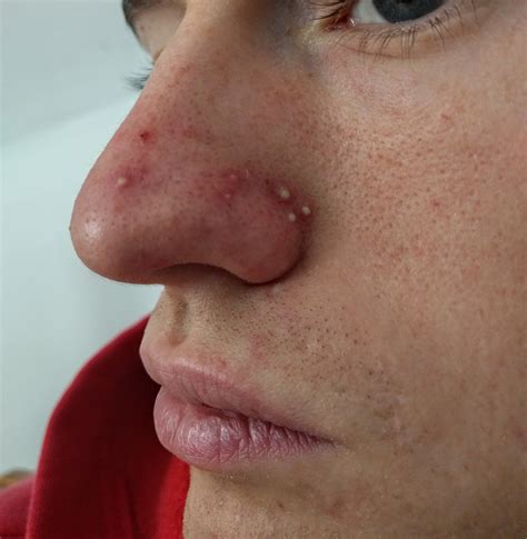 Skin Concerns What Are These White Spots On My Nose Skincareaddiction
