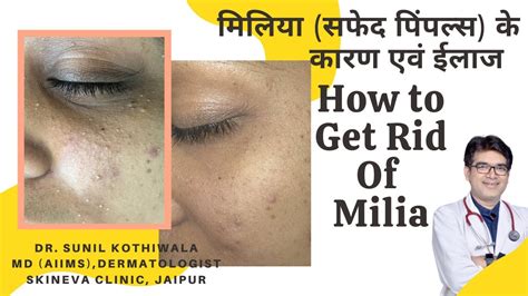 Milia को कैसे ठीक करे Milia Removal Treatment In Hindi Milia