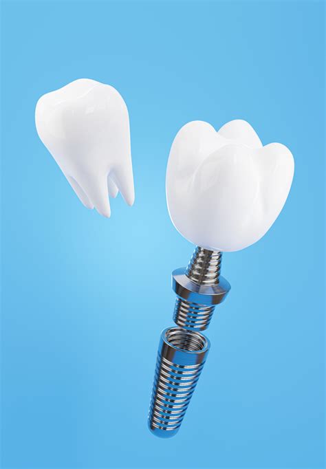 Implants Offer Tooth Replacement Santa Rosa Oral Surgery