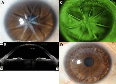 Central Corneal Opacity 27 Years After Radial Keratotomy Ophthalmology