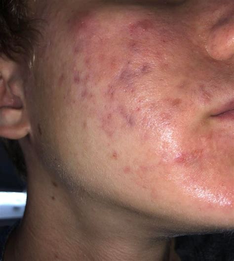 Acne Oily Prone Red Skin Acne Need Help With Oily Red And Acne
