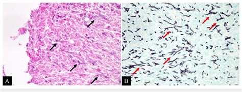 Surgical Specimens Stained Using Hematoxylin And Eosin A And Grocott