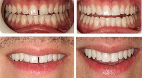 Composite Bonding In Stamford Hill London Northfield Dental Clinic