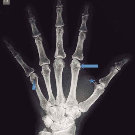 Lateral Radiograph Of The Wrist Showing The Sesamoid Anterior To The