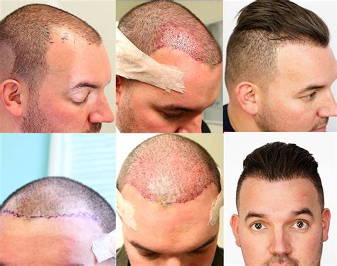Best Place To Go For Hair Transplant Molly Daily