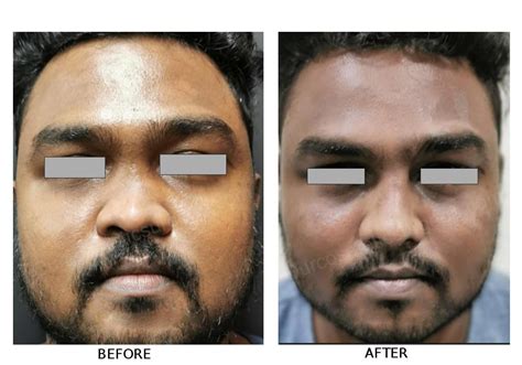 Wide Nose Rhinoplasty Before And After Before And After