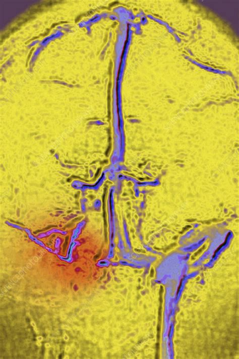 Cerebral Venous Thrombosis Angiography Stock Image C0555984