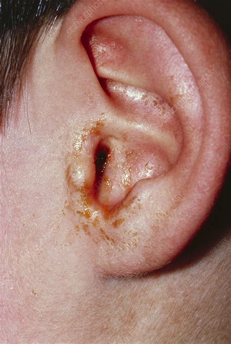 Ear Affected By Otitis Media Showing Pus Discharge Stock Image M157