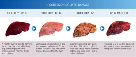 Which Disease Can Result In Cirrhosis Of The Liver Resultzx