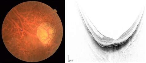 Highly Myopic Eye With Tessellated Fundus Inner Foveoschisis And