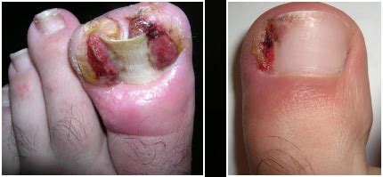 It begins as a microbial inflammation and causes the. Ingrown Toenails - Top 10 Make Up Cosmetics