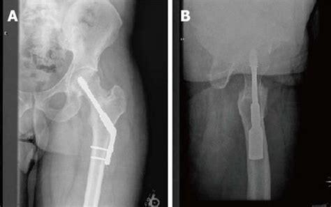 Management Of Femoral Neck Fractures In The Young Patient A Critical