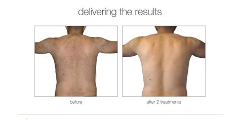 Laser Hair Removal Patel Medical And Aesthetics