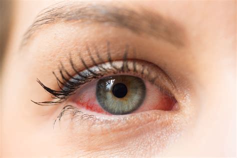 are dry eyes worse in winter st johns dry eye doctor