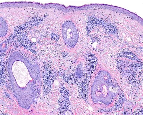 Pathology Outlines Chronic Cutaneous Lupus