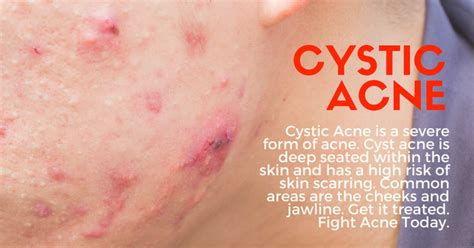 Cystic Acne Treatment Singapore Apax Medical And Aesthetics Clinic