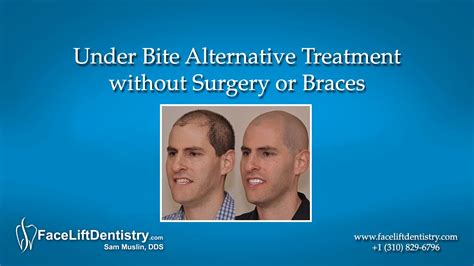 Underbite (class iii malocclusion/prognathism) is an orthodontic condition where lower teeth extend past upper teeth. Underbite Alternative Treatment without Surgery or Braces ...