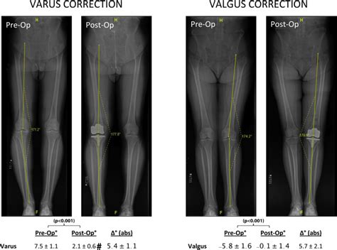 Impact Of Valgus Vs Varus Mechanical Axis Correction During Primary