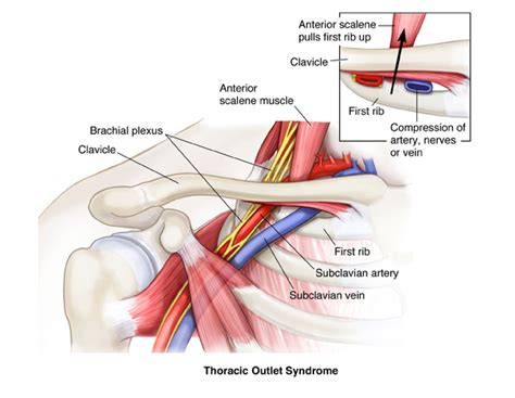Thoracic Outlet Syndrome Sport Med School
