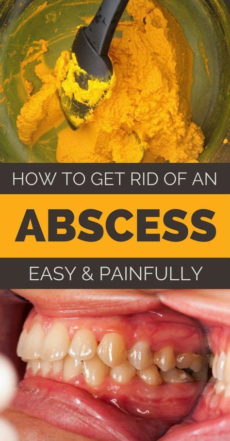 How To Get Rid Of An Abscess Painless And Naturally Tooth Infection