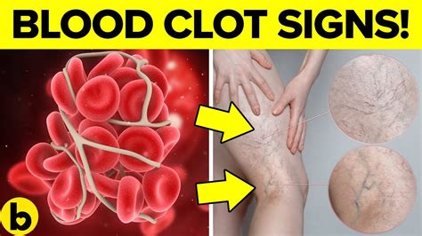 Symptoms Blood Clot Warning Signs