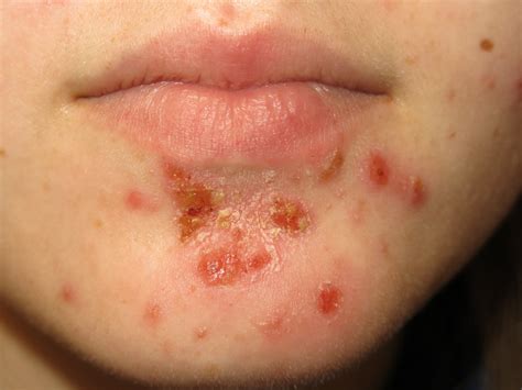 Impetigo Saudedia