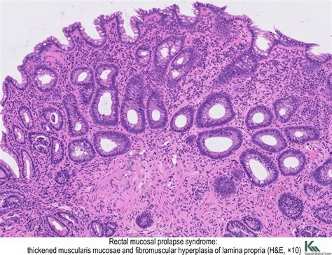 Solitary rectal ulcer syndrome in children and adolescents. Pathology Outlines - Solitary rectal ulcer syndrome