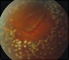 You'll be referred to hospital for surgery if tests show your retina may be detached or has started to come away (retinal tear). How to manage post-cataract retinal detachment
