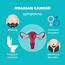 Ovarian Cancer Symptoms  Medicare Solutions Blog