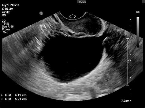 Check spelling or type a new query. Gynaecology Ultrasound - Women's Ultrasound Melbourne