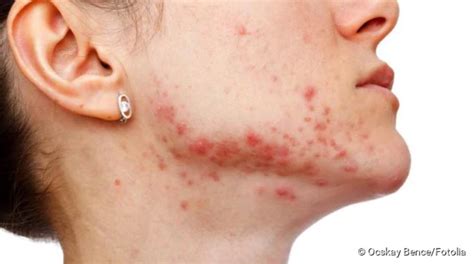 Treatment is usually given for 7 days in the absence. Shingles in the face: causes, course, prognosis - Medical Society