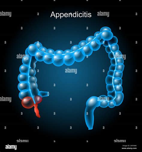 Appendicitis Inflammation Of The Appendix Large Intestine On Dark