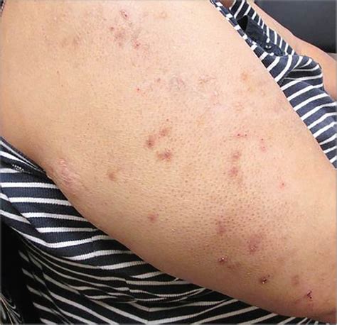 Overevaluating Chronic Pruritus A Teachable Moment Dermatology