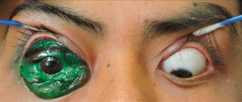 ✓ free for commercial use ✓ high quality images. Eye Tattoo Complications - Medical Videos