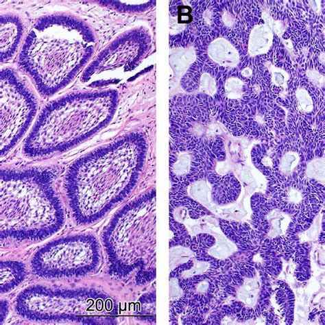 Histopathology Of Ameloblastoma A The Follicular Pattern With