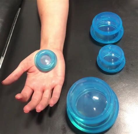 The Effects Of Cupping For Carpal Tunnel In Hand Therapy