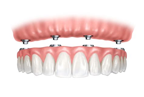 Implantes Clinica Dental Aviles Y Roman Clinica Dental Malaga My Xxx