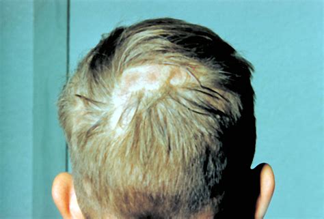 Public Domain Picture This Image Shows A Patient With Ringworm Of The