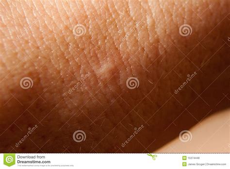 Bed Bug Bite Stock Photo Image Of Lesions Dermis Skin 15374448