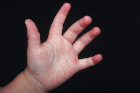 Hand Swelling In Children Livestrongcom