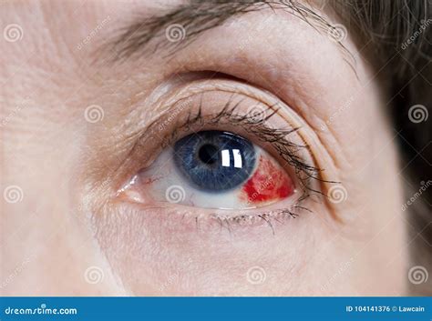 Subconjunctival Hemorrhage In Eye Stock Photo Image Of Breakage