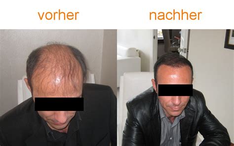 Aufrund der tollen ergebnisse habe ich die kur noch weitere 3. Unser Angebot zur Haartransplantation - tm haartrans