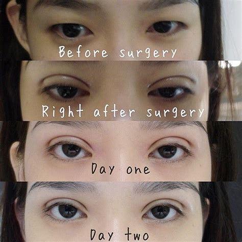 How To Make Your Eyes Bigger Surgery Canter Barbara